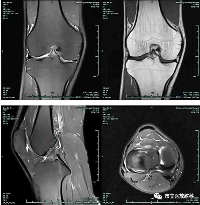 2膝關節(jié)MRI圖像_副本.jpg