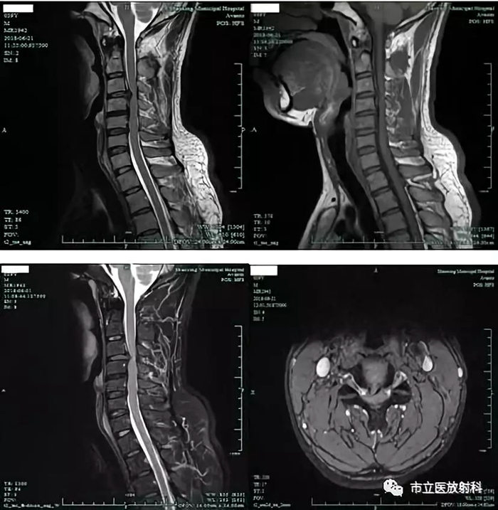 4頸椎MRI圖像_副本.jpg